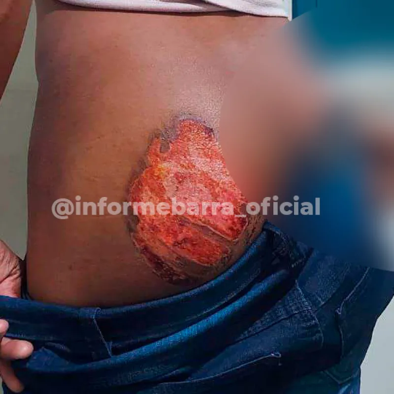 Livramento: Patrões são presos acusados de marcarem nádegas de funcionário surdo-mudo com ferro quente