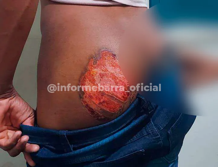 Livramento: Patrões são presos acusados de marcarem nádegas de funcionário surdo-mudo com ferro quente